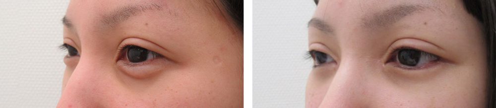 目尻切開術/目頭切開術/グラマラスライン（タレ目形成）の症例写真 施術前後 ３ヵ月