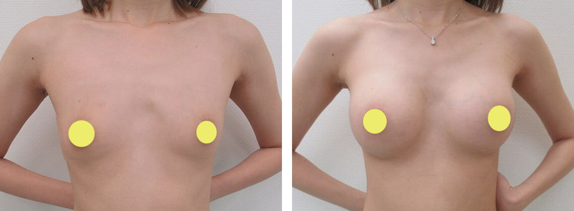 シリコンバッグ豊胸(人工乳腺バッグ)の症例写真 施術前後 1ヵ月
