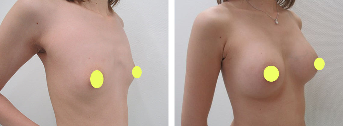 シリコンバッグ豊胸(人工乳腺バッグ)の症例写真 施術前後 1ヵ月