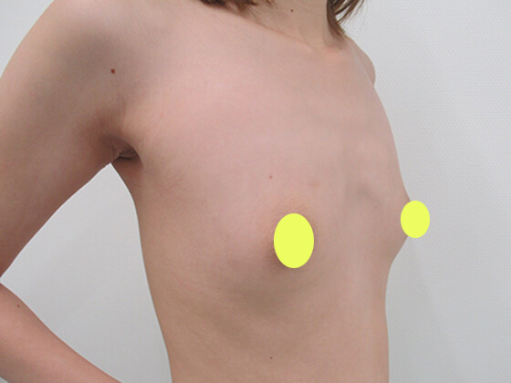 症例写真 ダウンタイム 憧れのeカップ Taクリニック 美容整形 美容外科 新宿 銀座 横浜 大阪 福岡 川越 高崎 Taクリニック 美容整形 美容外科