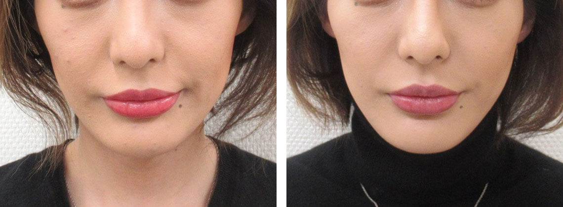 頬骨下の窪みの改善