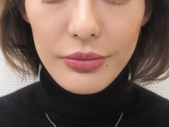 症例写真 ダウンタイム 頬骨下の窪みの改善 Taクリニック 美容整形 美容外科 新宿 銀座 横浜 大阪 福岡 川越 高崎 Taクリニック 美容整形 美容外科