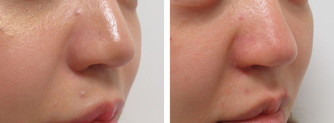 鼻孔縁挙上術の症例写真 施術前後 １ヵ月