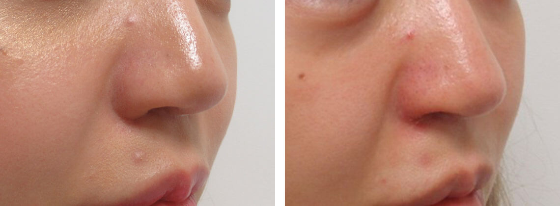鼻孔縁挙上術の症例写真 施術前後 １週間