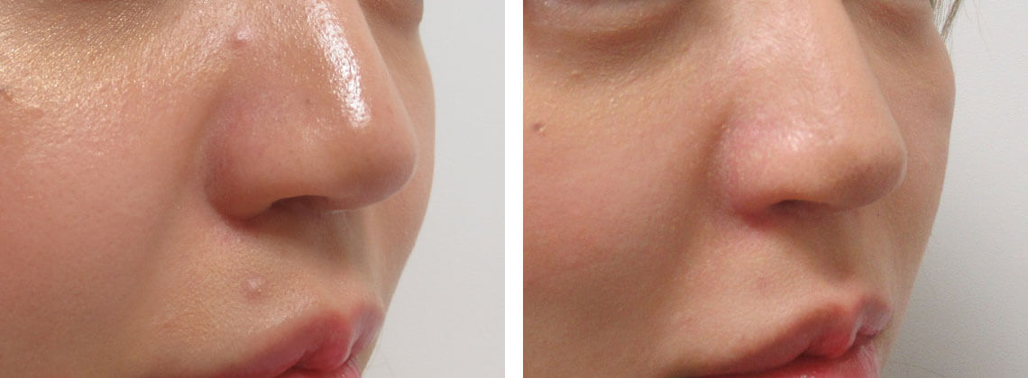 鼻翼挙上効果も出ます