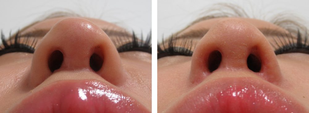 鼻孔縁挙上術の症例写真 施術前後 ２ヵ月