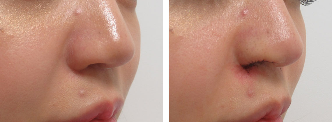 鼻孔縁挙上術の症例写真 施術前後 直後