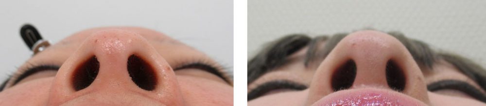 鼻尖4Dノーズ/ヴィーナスノーズ（切らない鼻中隔延長術）/TAC式 鼻翼縮小術（小鼻縮小）の症例写真 施術前後 １０ヵ月