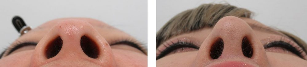 お鼻の大改造的整形