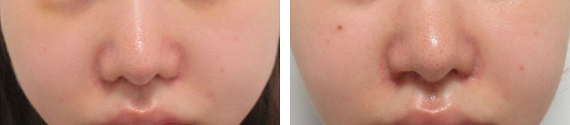 他院鼻翼縮小内側法の修正