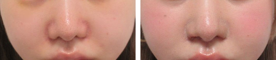 鼻孔縁挙上術の症例写真 施術前後 １週間