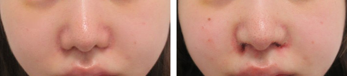 鼻孔縁挙上術の症例写真 施術前後 直後