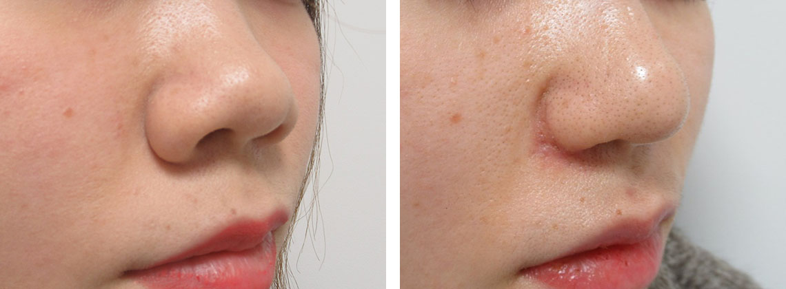 TAC式 鼻翼縮小術（小鼻縮小）/鼻尖4Dノーズ/鼻翼挙上術の症例写真 施術前後 ２度目の施術から１ヵ月