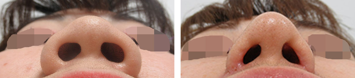 TAC式 鼻翼縮小術（小鼻縮小）/鼻尖4Dノーズ/鼻翼挙上術の症例写真 施術前後 ２度目の施術から１ヵ月