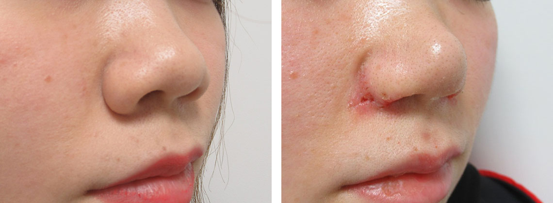 TAC式 鼻翼縮小術（小鼻縮小）/鼻尖4Dノーズ/鼻翼挙上術の症例写真 施術前後 ２度目の施術から１週間