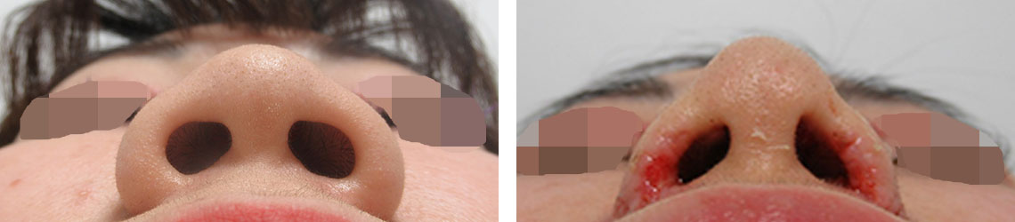 TAC式 鼻翼縮小術（小鼻縮小）/鼻尖4Dノーズ/鼻翼挙上術の症例写真 施術前後 ２度目の施術から１週間