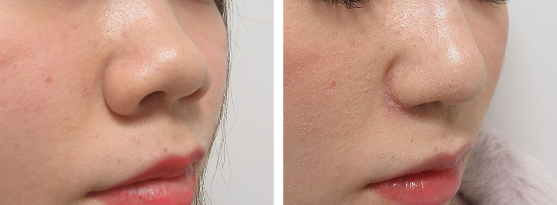 お鼻の整形組み合わせです