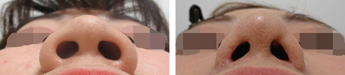 TAC式 鼻翼縮小術（小鼻縮小）/鼻尖4Dノーズ/鼻翼挙上術の症例写真 施術前後 ２度目の施術から２ヵ月