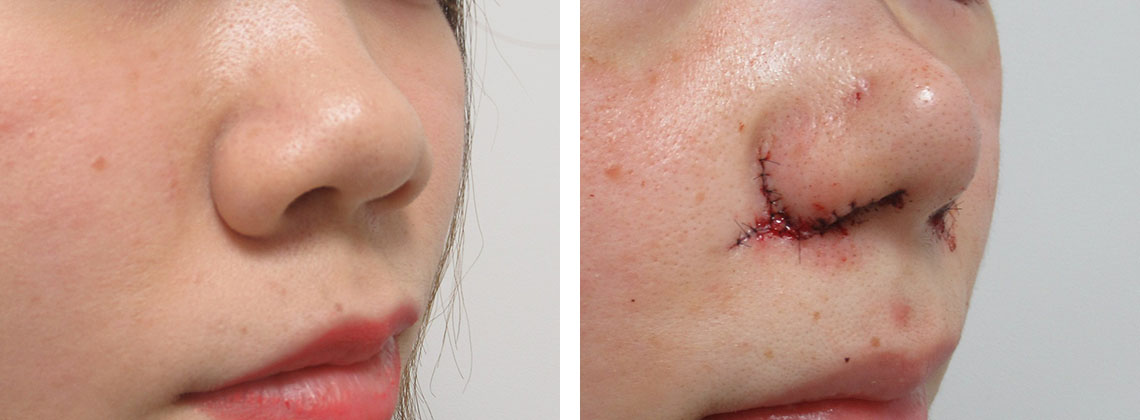 TAC式 鼻翼縮小術（小鼻縮小）/鼻尖4Dノーズ/鼻翼挙上術の症例写真 施術前後 直後