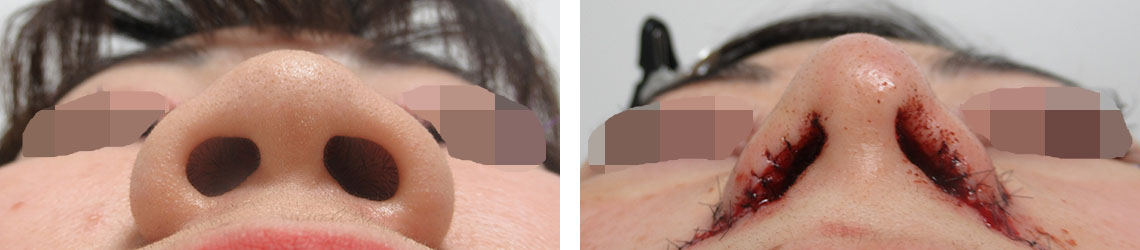 TAC式 鼻翼縮小術（小鼻縮小）/鼻尖4Dノーズ/鼻翼挙上術の症例写真 施術前後 直後