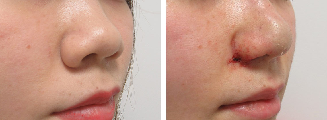 TAC式 鼻翼縮小術（小鼻縮小）/鼻尖4Dノーズ/鼻翼挙上術の症例写真 施術前後 ２度目の施術直後