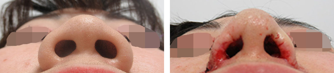 TAC式 鼻翼縮小術（小鼻縮小）/鼻尖4Dノーズ/鼻翼挙上術の症例写真 施術前後 ２度目の施術直後