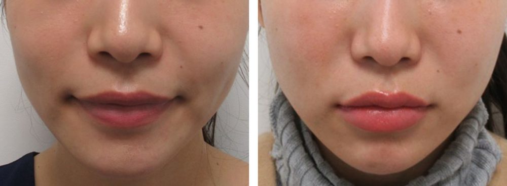 TAC式 ツヤ肌コラーゲンリフト®/ヒアルロン酸注射:その他の症例写真 施術前後 1.5ヵ月