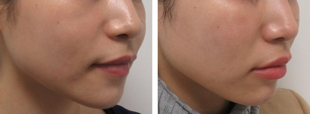 TAC式 ツヤ肌コラーゲンリフト®/ヒアルロン酸注射:その他の症例写真 施術前後 1.5ヵ月