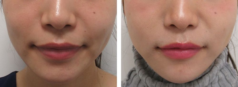 TAC式 ツヤ肌コラーゲンリフト®/ヒアルロン酸注射:その他の症例写真 施術前後 1週間