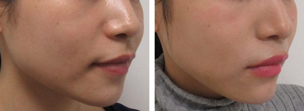 TAC式 ツヤ肌コラーゲンリフト®/ヒアルロン酸注射:その他の症例写真 施術前後 1週間