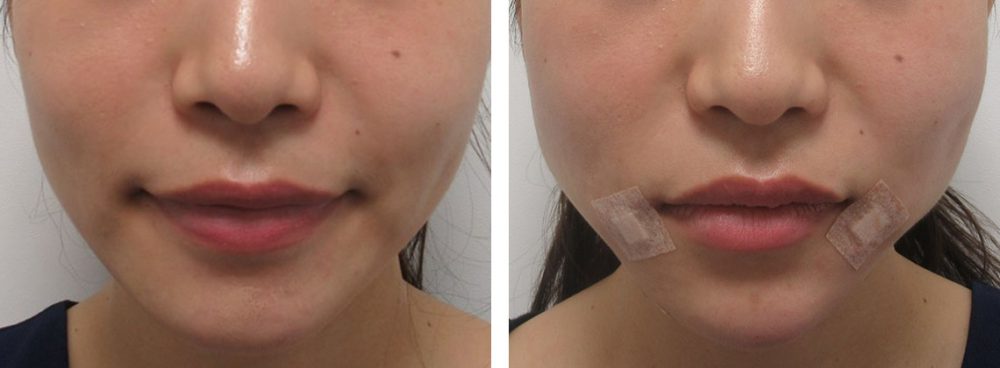 TAC式 ツヤ肌コラーゲンリフト®/ヒアルロン酸注射:その他の症例写真 施術前後 直後