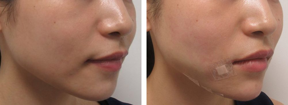 TAC式 ツヤ肌コラーゲンリフト®/ヒアルロン酸注射:その他の症例写真 施術前後 直後