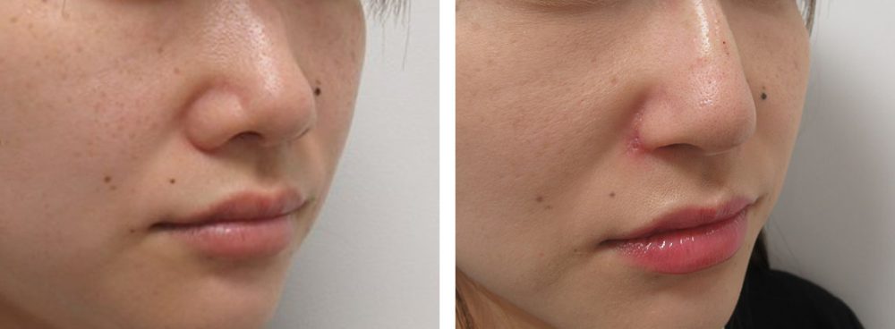 TAC式 鼻翼縮小術（小鼻縮小）/鼻尖形成・鼻尖縮小/鼻孔縁挙上術の症例写真 施術前後 １ヵ月