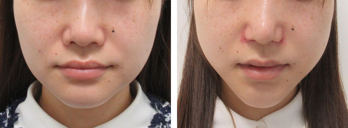 TAC式 鼻翼縮小術（小鼻縮小）/鼻尖形成・鼻尖縮小/鼻孔縁挙上術の症例写真 施術前後 １週間