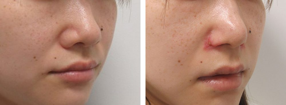 TAC式 鼻翼縮小術（小鼻縮小）/鼻尖形成・鼻尖縮小/鼻孔縁挙上術の症例写真 施術前後 １週間