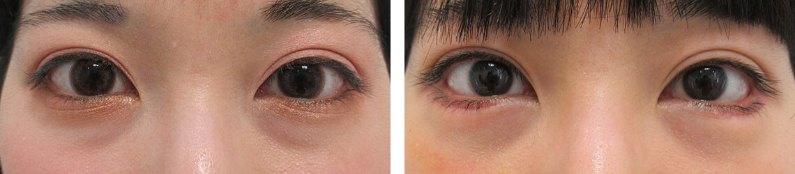 グラマラスライン（タレ目形成）/下眼瞼脱脂術（目の下のたるみ取り・目の下の脂肪ふくらみ取り）の症例写真 施術前後 １週間