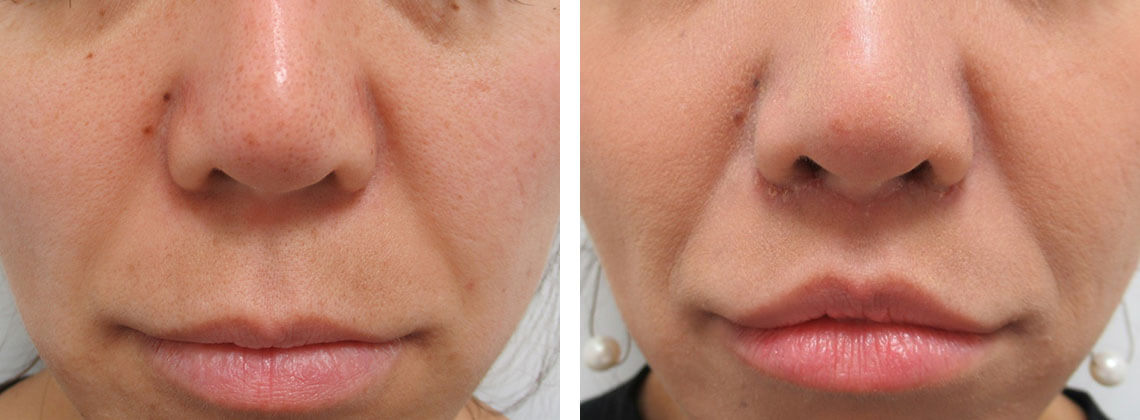 人中短縮術(リップリフト)・外側人中短縮術の症例写真 施術前後 ２週間