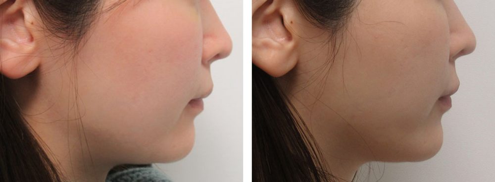 アゴにヒアルロン酸を注入しEラインをつくる