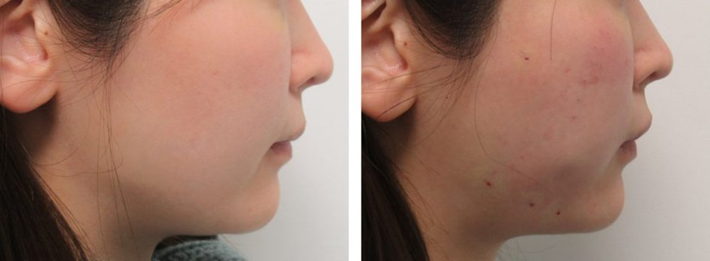 ヒアルロン酸注射：その他/ボトックス注射：その他/TAC式 ツヤ肌コラーゲンリフト®の症例写真 施術前後 直後