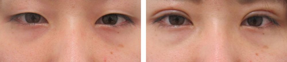 二重埋没法の症例写真 施術前後 １週間