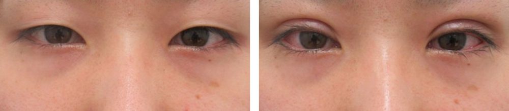 二重埋没法の症例写真 施術前後 直後