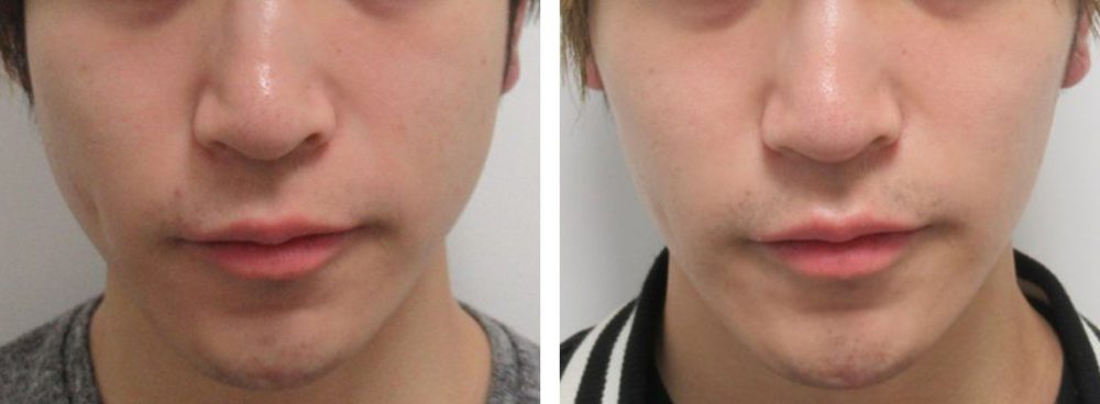 TAC式 ツヤ肌コラーゲンリフト®/ボトックス注射：その他の症例写真 施術前後 １ヵ月