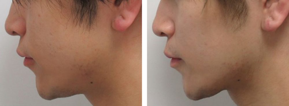 TAC式 ツヤ肌コラーゲンリフト®/ボトックス注射：その他の症例写真 施術前後 １ヵ月