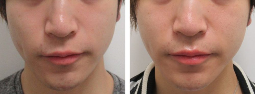 TAC式 ツヤ肌コラーゲンリフト®/ボトックス注射：その他の症例写真 施術前後 １週間