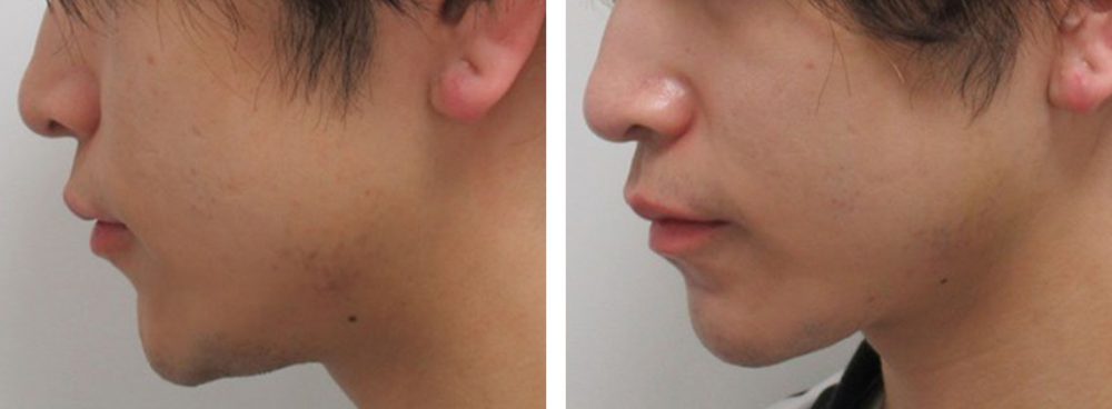 TAC式 ツヤ肌コラーゲンリフト®/ボトックス注射：その他の症例写真 施術前後 １週間