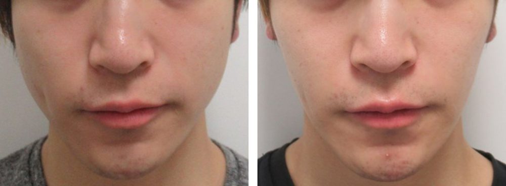 TAC式 ツヤ肌コラーゲンリフト®/ボトックス注射：その他の症例写真 施術前後 ３.５ヵ月