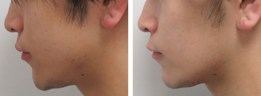 TAC式 ツヤ肌コラーゲンリフト®/ボトックス注射：その他の症例写真 施術前後 ３.５ヵ月