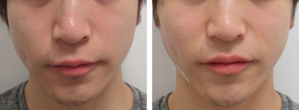 TAC式 ツヤ肌コラーゲンリフト®/ボトックス注射：その他の症例写真 施術前後 直後