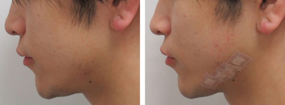 TAC式 ツヤ肌コラーゲンリフト®/ボトックス注射：その他の症例写真 施術前後 直後