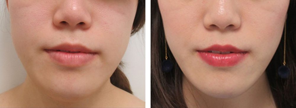 引き締まったフェイスライン